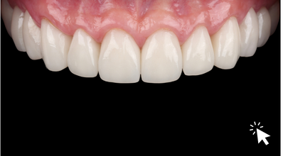Carilla-dental